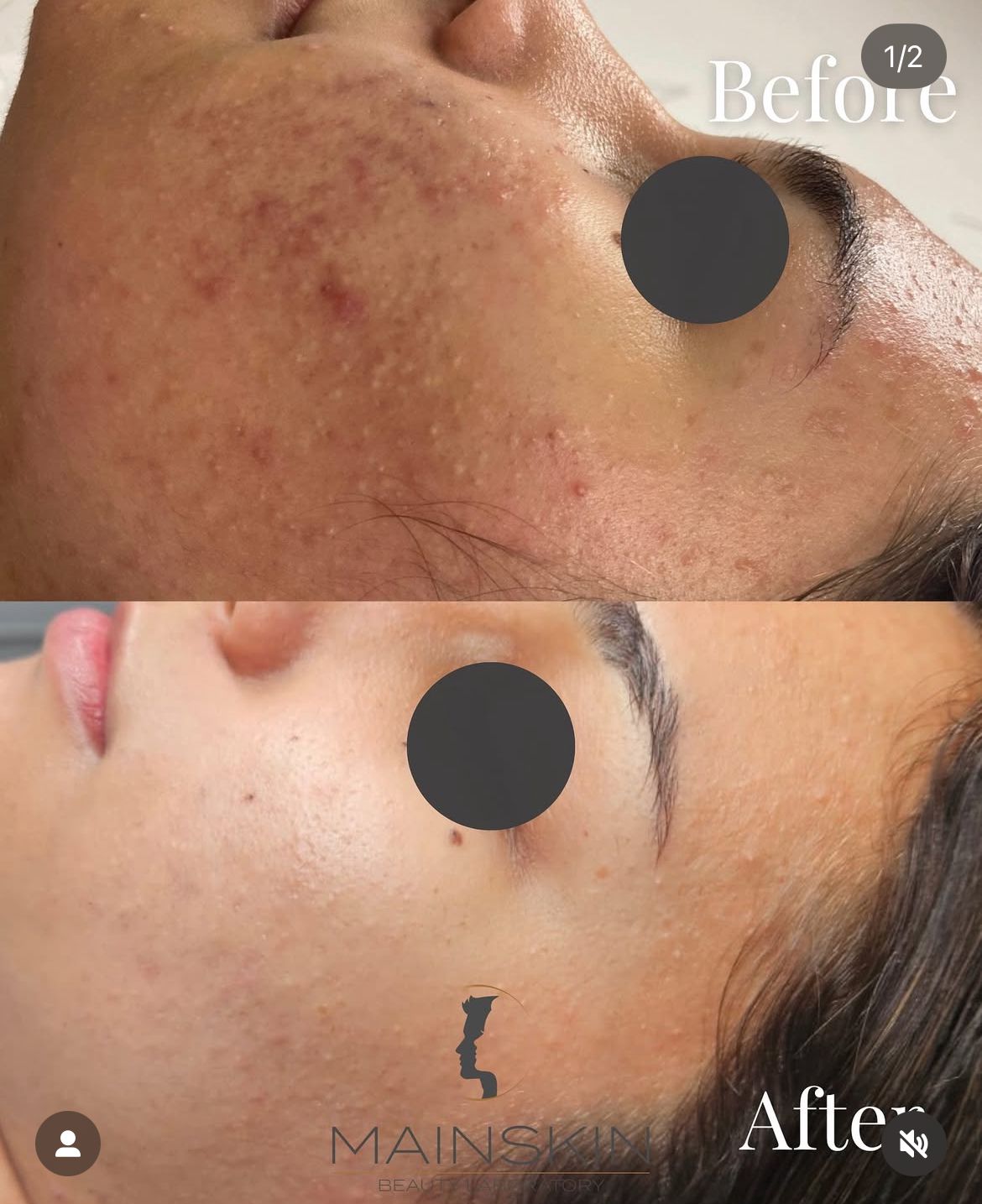 Vorher-Nachher Gesichtsbehandlung Mainskin